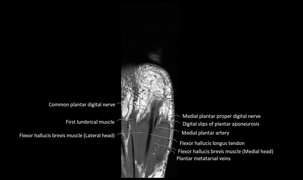 Great Toe micro anatomy MRI axial cross sectional 3T image 24.webp
